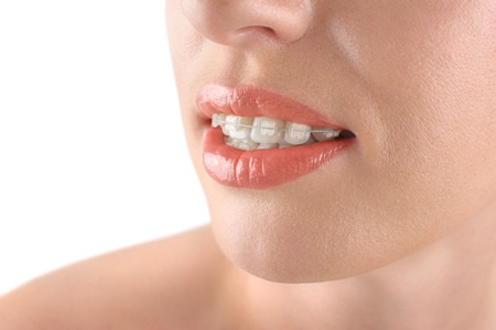 woman wearing tooth-colored ceramic clear braces