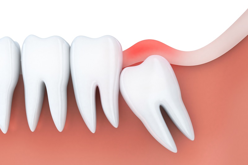 Impacted widom tooth