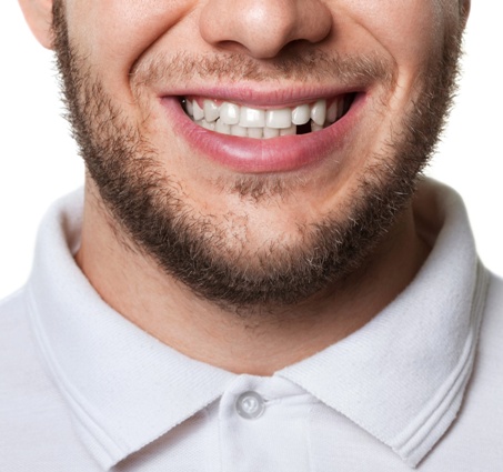 young man missing a tooth